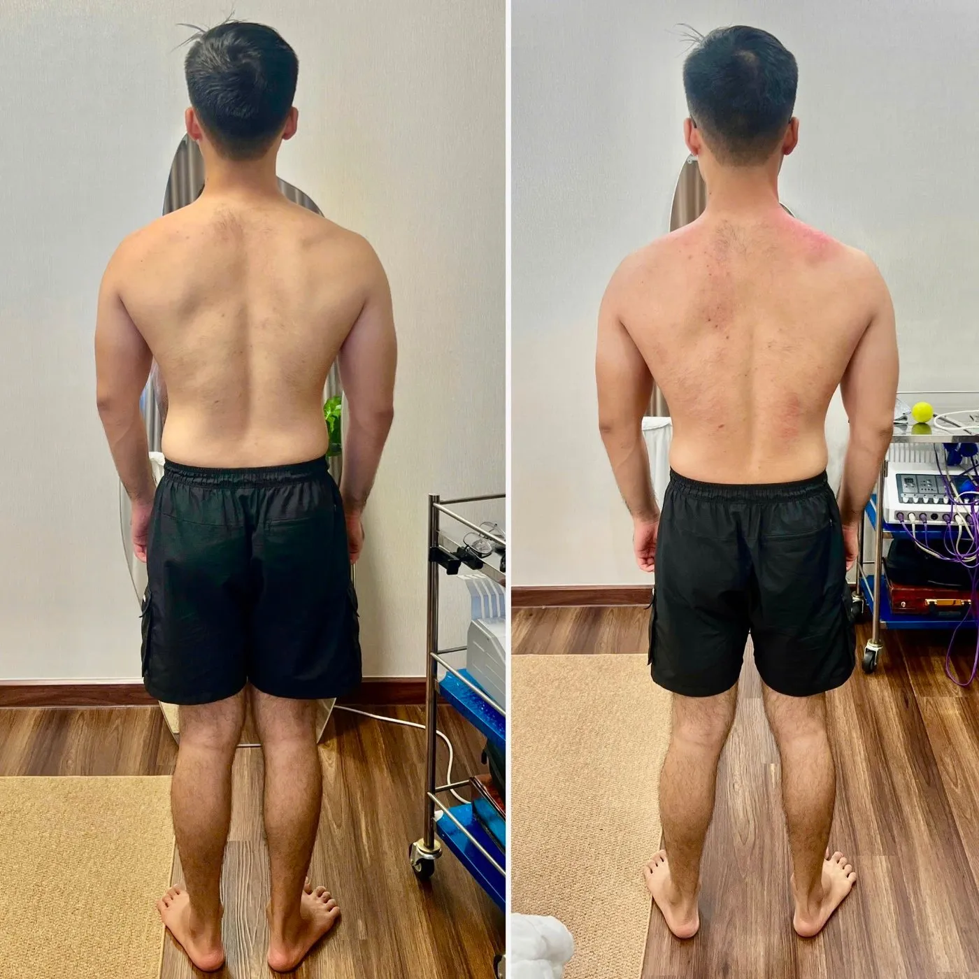 Vùng vai và lưng trên của khách nam, trước và sau buổi trị liệu tại AN