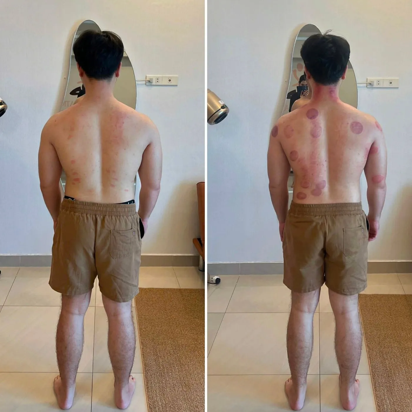 Vai và lưng trên của khách nam, trước và sau buổi trị liệu tại AN